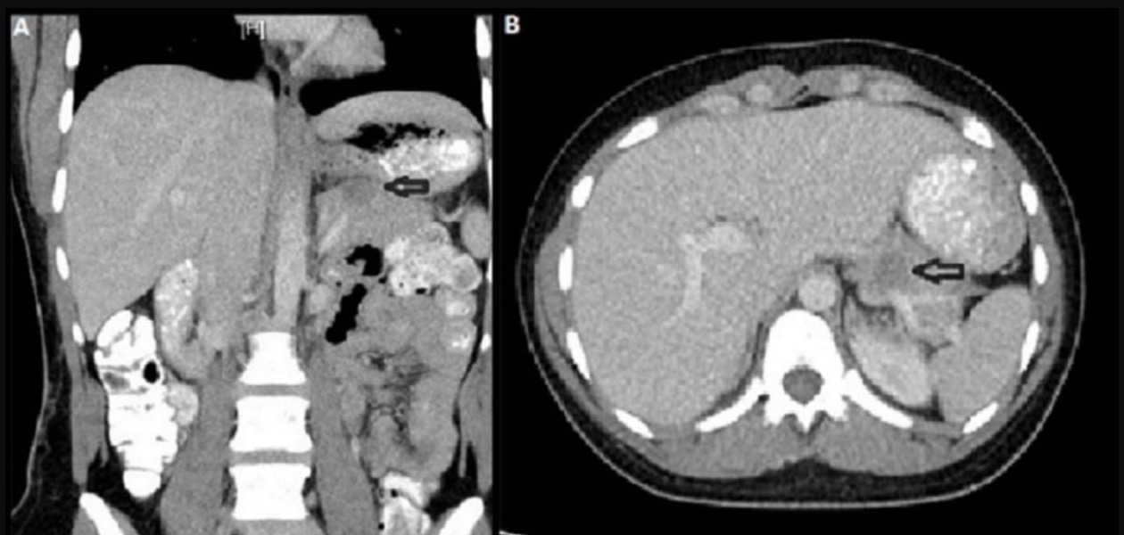 Open-access CT example: a 2 × 2 cm indeterminate pancreatic tail lesion.